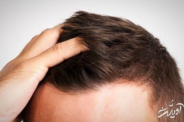 آب آلبالو برای افزایش رشد مو رشد مو